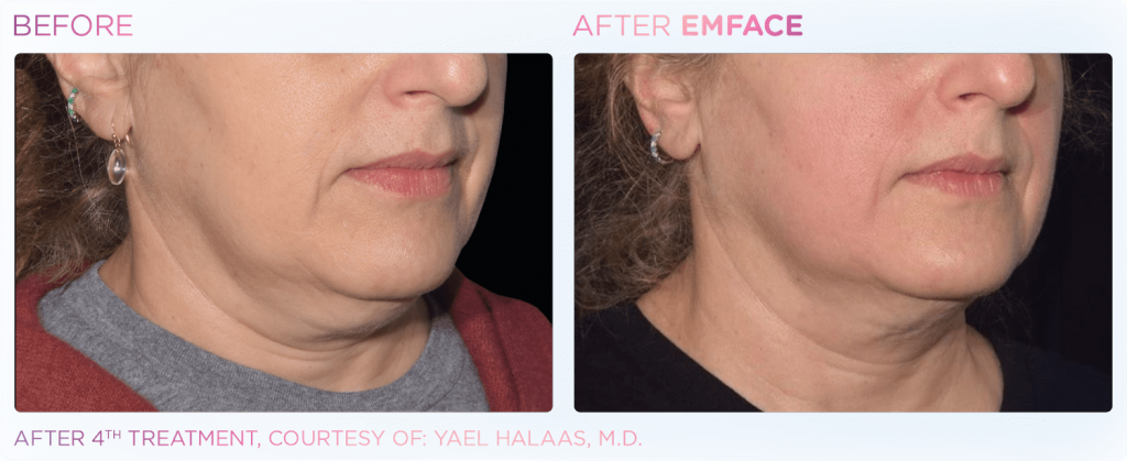 EmFace - procedūra sejas liftingam un gludai ādai | Pirms | Pēc
