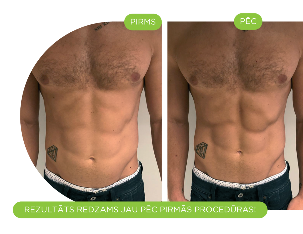 EmSculpt pirms-pēc