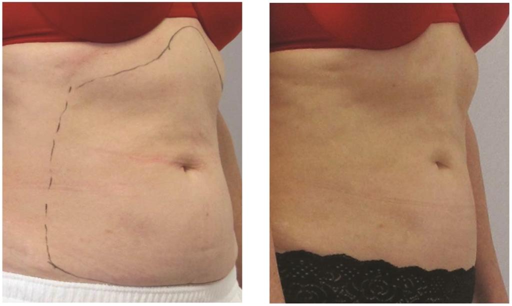 Venus Legacy Proced ras Anti Aging Institute Venus Legacy Proced ras Anti Aging Institute