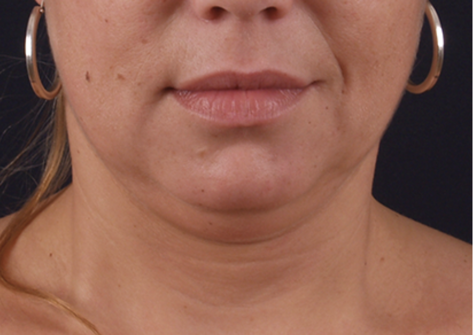 Pirms Exilis Elite sejas procedūras