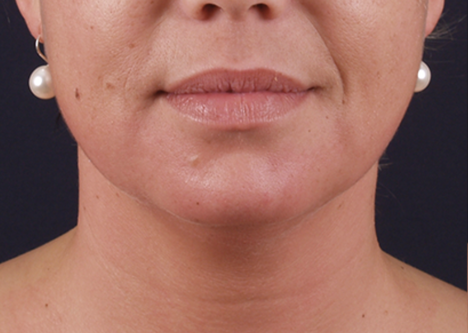 Pēc Exilis Elite sejas procedūras