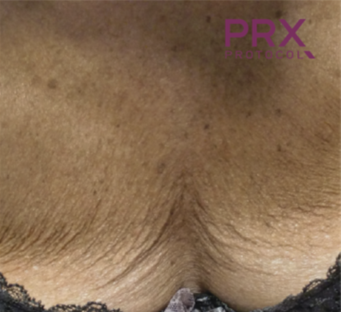 Pirms PRX-T33 procedūras
